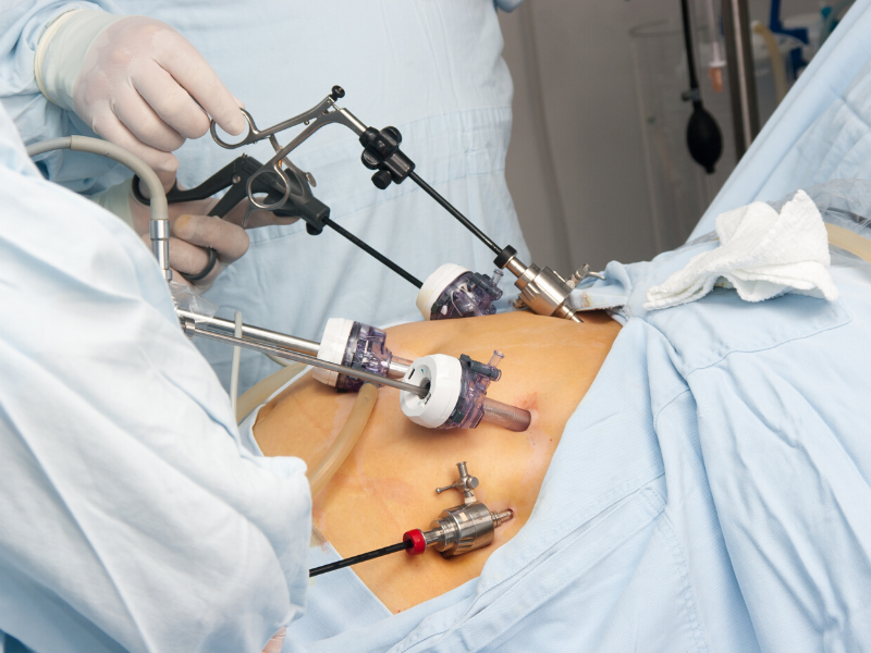 laparoscopic excision is the gold standard in treatment. Here are questions to ask your doctor.